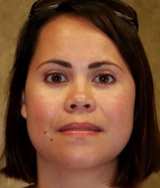 Face Surgery